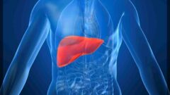 Karaciğer Yağlanması Nedir? Karaciğer Yağlanması Belirtileri ve Tedavisi