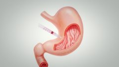 Mide Botoksu Nedir? Mide Botoksu Nasıl Yapılır?