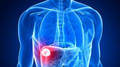 Karaciğer Kanseri Nedir? Karaciğer Kanseri’nin Belirtileri Nelerdir?