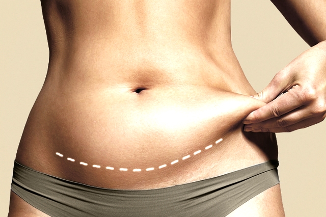 Liposuction Nedir? Liposuction Kimlere Yapılır?